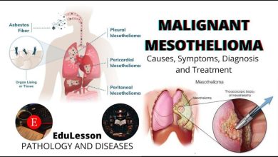Mesothelioma Malignant