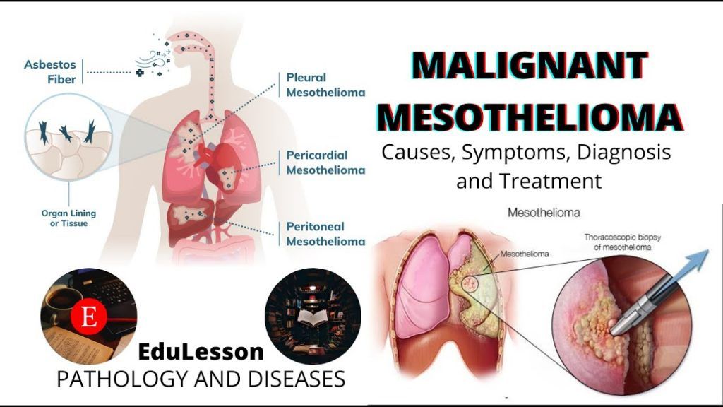 Mesothelioma Malignant